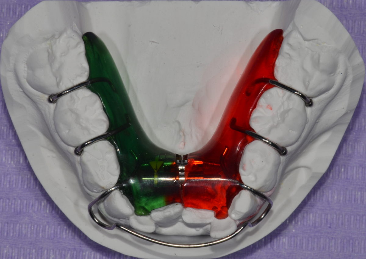 5x Vite Di Espansione Ortodontica Dentale Morelli RPE Palatale Split